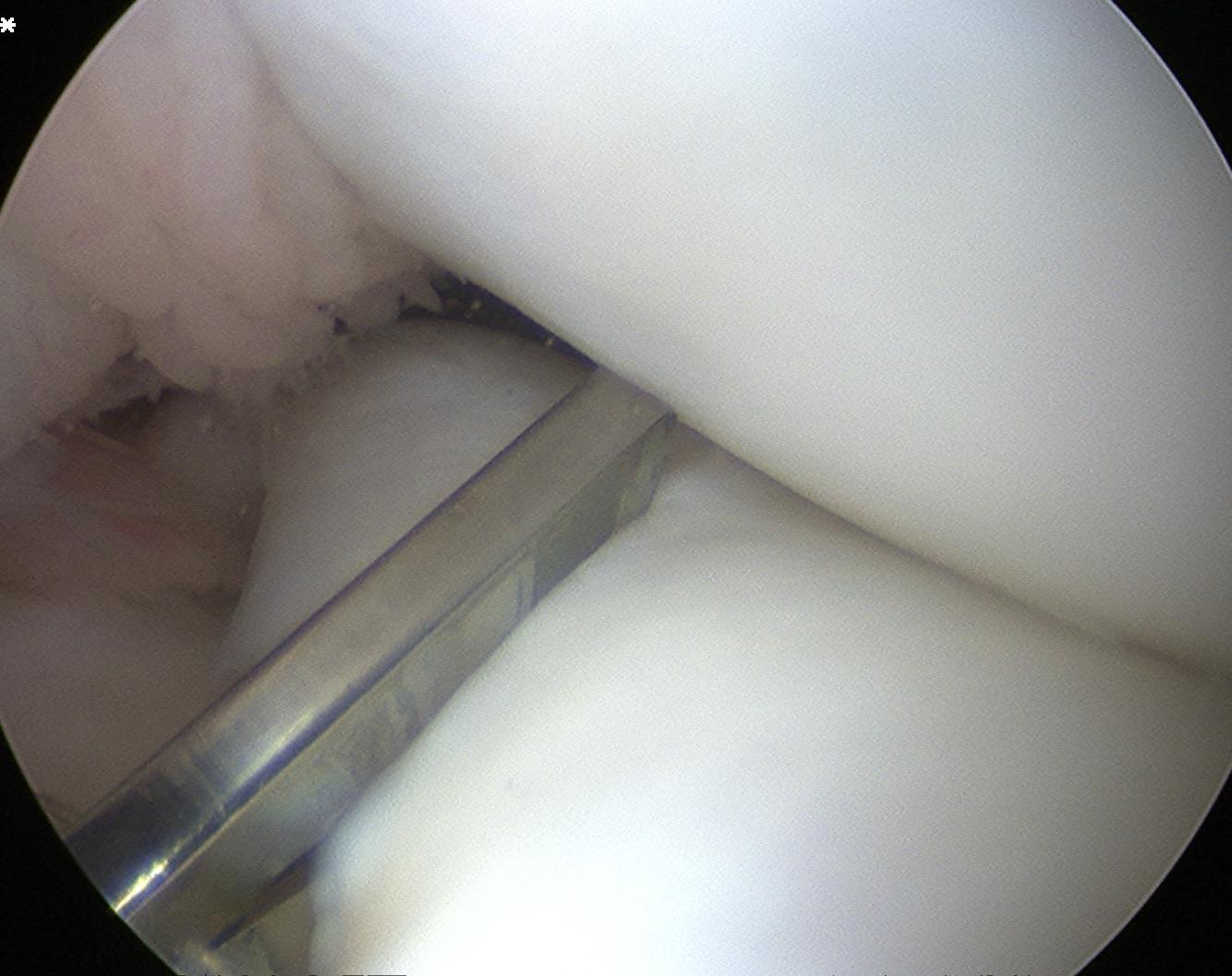 Discoid Meniscus Saucerisation 1